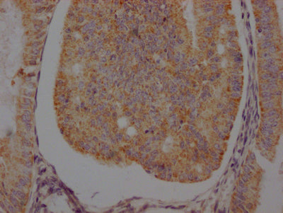 IHC image of RAC07182 diluted at 1:100 and staining in paraffin-embedded human endometrial cancer performed on a Leica BondTM system. After dewaxing and hydration, antigen retrieval was mediated by high pressure in a citrate buffer (pH 6.0). Section was blocked with 10% normal goat serum 30min at RT. Then primary antibody (1% BSA) was incubated at 4? overnight. The primary is detected by a Goat anti-rabbit IgG polymer labeled by HRP and visualized using 0.05% DAB.