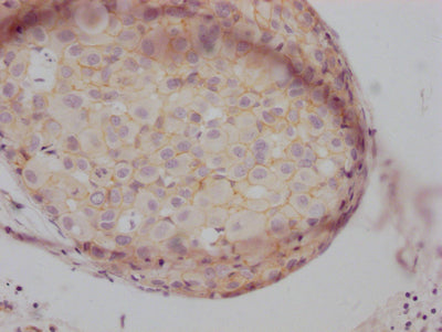 IHC image of RAC07183 diluted at 1:100 and staining in paraffin-embedded human breast cancer performed on a Leica BondTM system. After dewaxing and hydration, antigen retrieval was mediated by high pressure in a citrate buffer (pH 6.0). Section was blocked with 10% normal goat serum 30min at RT. Then primary antibody (1% BSA) was incubated at 4? overnight. The primary is detected by a Goat anti-rabbit IgG polymer labeled by HRP and visualized using 0.05% DAB.