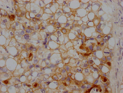 IHC image of RAC07183 diluted at 1:100 and staining in paraffin-embedded human liver cancer performed on a Leica BondTM system. After dewaxing and hydration, antigen retrieval was mediated by high pressure in a citrate buffer (pH 6.0). Section was blocked with 10% normal goat serum 30min at RT. Then primary antibody (1% BSA) was incubated at 4? overnight. The primary is detected by a Goat anti-rabbit IgG polymer labeled by HRP and visualized using 0.05% DAB.