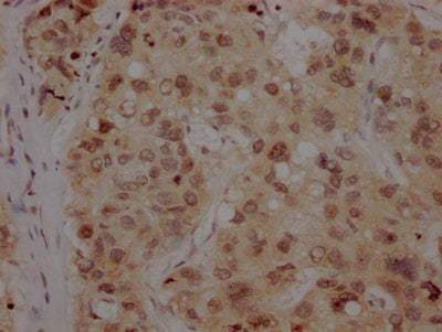 IHC image of RAC07184 diluted at 1:100 and staining in paraffin-embedded human liver cancer performed on a Leica BondTM system. After dewaxing and hydration, antigen retrieval was mediated by high pressure in a citrate buffer (pH 6.0). Section was blocked with 10% normal goat serum 30min at RT. Then primary antibody (1% BSA) was incubated at 4? overnight. The primary is detected by a Goat anti-rabbit IgG polymer labeled by HRP and visualized using 0.05% DAB.