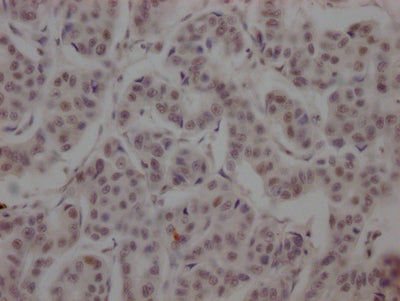 IHC image of RAC07187 diluted at 1:100 and staining in paraffin-embedded human breast cancer performed on a Leica BondTM system. After dewaxing and hydration, antigen retrieval was mediated by high pressure in a citrate buffer (pH 6.0). Section was blocked with 10% normal goat serum 30min at RT. Then primary antibody (1% BSA) was incubated at 4? overnight. The primary is detected by a Goat anti-rabbit IgG polymer labeled by HRP and visualized using 0.05% DAB.