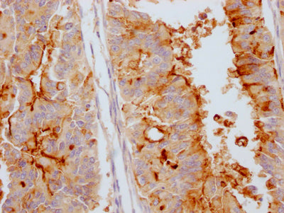 IHC image of RAC07195 diluted at 1:100 and staining in paraffin-embedded human endometrial cancer performed on a Leica BondTM system. After dewaxing and hydration, antigen retrieval was mediated by high pressure in a citrate buffer (pH 6.0). Section was blocked with 10% normal goat serum 30min at RT. Then primary antibody (1% BSA) was incubated at 4? overnight. The primary is detected by a Goat anti-rabbit IgG polymer labeled by HRP and visualized using 0.05% DAB.