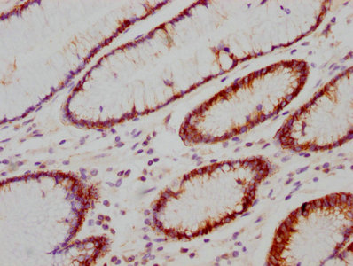 IHC image of RAC07196 diluted at 1:118 and staining in paraffin-embedded human gastric cancer performed on a Leica BondTM system. After dewaxing and hydration, antigen retrieval was mediated by high pressure in a citrate buffer (pH 6.0). Section was blocked with 10% normal goat serum 30min at RT. Then primary antibody (1% BSA) was incubated at 4? overnight. The primary is detected by a biotinylated secondary antibody and visualized using an HRP conjugated SP system.