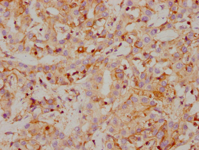 IHC image of RAC07196 diluted at 1:118 and staining in paraffin-embedded human liver cancer performed on a Leica BondTM system. After dewaxing and hydration, antigen retrieval was mediated by high pressure in a citrate buffer (pH 6.0). Section was blocked with 10% normal goat serum 30min at RT. Then primary antibody (1% BSA) was incubated at 4? overnight. The primary is detected by a biotinylated secondary antibody and visualized using an HRP conjugated SP system.