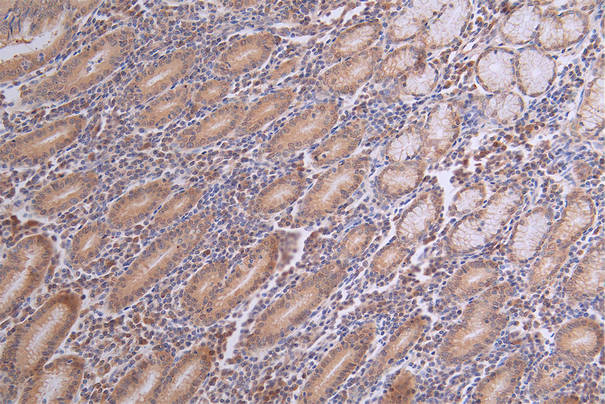 IHC image of RAC07199 diluted at 1:100 and staining in paraffin-embedded human breast cancer performed on a Leica BondTM system. After dewaxing and hydration, antigen retrieval was mediated by high pressure in a citrate buffer (pH 6.0). Section was blocked with 10% normal goat serum 30min at RT. Then primary antibody (1% BSA) was incubated at 4Â°C overnight. The primary is detected by a Goat anti-rabbit polymer IgG labeled by HRP and visualized using 0.18% DAB.