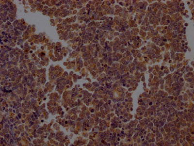 IHC image of RAC07203 diluted at 1:100 and staining in paraffin-embedded human lung cancer performed on a Leica BondTM system. After dewaxing and hydration, antigen retrieval was mediated by high pressure in a citrate buffer (pH 6.0). Section was blocked with 10% normal goat serum 30min at RT. Then primary antibody (1% BSA) was incubated at 4? overnight. The primary is detected by a Goat anti-rabbit IgG polymer labeled by HRP and visualized using 0.05% DAB.