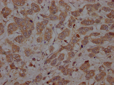 IHC image of RAC07204 diluted at 1:100 and staining in paraffin-embedded human breast cancer performed on a Leica BondTM system. After dewaxing and hydration, antigen retrieval was mediated by high pressure in a citrate buffer (pH 6.0). Section was blocked with 10% normal goat serum 30min at RT. Then primary antibody (1% BSA) was incubated at 4? overnight. The primary is detected by a Goat anti-rabbit IgG polymer labeled by HRP and visualized using 0.05% DAB.