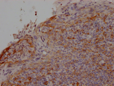 IHC image of RAC07209 diluted at 1:100 and staining in paraffin-embedded human tonsil tissue performed on a Leica BondTM system. After dewaxing and hydration, antigen retrieval was mediated by high pressure in a citrate buffer (pH 6.0). Section was blocked with 10% normal goat serum 30min at RT. Then primary antibody (1% BSA) was incubated at 4? overnight. The primary is detected by a Goat anti-rabbit IgG polymer labeled by HRP and visualized using 0.05% DAB.