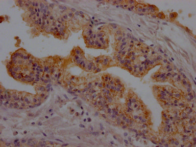 IHC image of RAC07217 diluted at 1:100 and staining in paraffin-embedded human prostate cancer performed on a Leica BondTM system. After dewaxing and hydration, antigen retrieval was mediated by high pressure in a citrate buffer (pH 6.0). Section was blocked with 10% normal goat serum 30min at RT. Then primary antibody (1% BSA) was incubated at 4? overnight. The primary is detected by a Goat anti-rabbit IgG polymer labeled by HRP and visualized using 0.05% DAB.