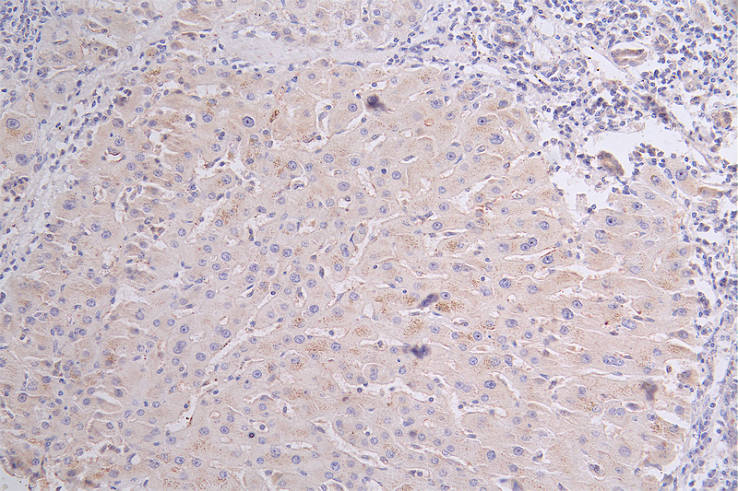 IHC image of RAC07221 diluted at 1:100 and staining in paraffin-embedded human liver cancer performed on a Leica BondTM system. After dewaxing and hydration, antigen retrieval was mediated by high pressure in a citrate buffer (pH 6.0). Section was blocked with 10% normal goat serum 30min at RT. Then primary antibody (1% BSA) was incubated at 4Â°C overnight. The primary is detected by a Goat anti-rabbit polymer IgG labeled by HRP and visualized using 0.25% DAB.