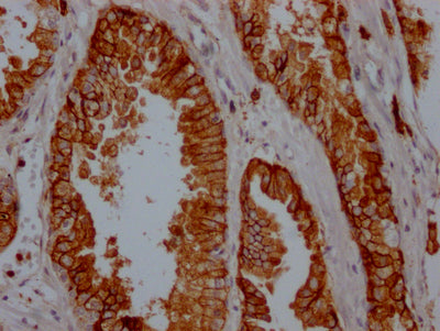 IHC image of RAC07222 diluted at 1:100 and staining in paraffin-embedded human prostate cancer performed on a Leica BondTM system. After dewaxing and hydration, antigen retrieval was mediated by high pressure in a citrate buffer (pH 6.0). Section was blocked with 10% normal goat serum 30min at RT. Then primary antibody (1% BSA) was incubated at 4? overnight. The primary is detected by a Goat anti-rabbit IgG polymer labeled by HRP and visualized using 0.05% DAB.