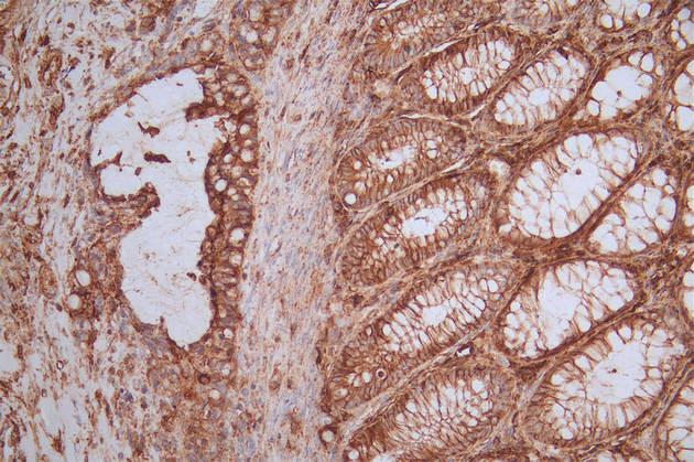 IHC image of RAC07223 diluted at 1:50 and staining in paraffin-embedded human rectal cancer performed on a Leica BondTM system. After dewaxing and hydration, antigen retrieval was mediated by high pressure in a citrate buffer (pH 6.0). Section was blocked with 10% normal goat serum 30min at RT. Then primary antibody (1% BSA) was incubated at 4Â°C overnight. The primary is detected by a Goat anti-rabbit polymer IgG labeled by HRP and visualized using 0.51% DAB.