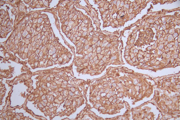 IHC image of RAC07223 diluted at 1:50 and staining in paraffin-embedded human lung cancer performed on a Leica BondTM system. After dewaxing and hydration, antigen retrieval was mediated by high pressure in a citrate buffer (pH 6.0). Section was blocked with 10% normal goat serum 30min at RT. Then primary antibody (1% BSA) was incubated at 4Â°C overnight. The primary is detected by a Goat anti-rabbit polymer IgG labeled by HRP and visualized using 0.51% DAB.