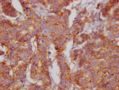 IHC image of RAC07224 diluted at 1:100 and staining in paraffin-embedded human breast cancer performed on a Leica BondTM system. After dewaxing and hydration, antigen retrieval was mediated by high pressure in a citrate buffer (pH 6.0). Section was blocked with 10% normal goat serum 30min at RT. Then primary antibody (1% BSA) was incubated at 4? overnight. The primary is detected by a Goat anti-rabbit IgG polymer labeled by HRP and visualized using 0.05% DAB.