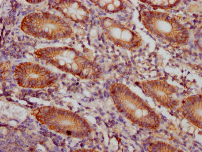 IHC image of RAC07224 diluted at 1:100 and staining in paraffin-embedded human colon cancer performed on a Leica BondTM system. After dewaxing and hydration, antigen retrieval was mediated by high pressure in a citrate buffer (pH 6.0). Section was blocked with 10% normal goat serum 30min at RT. Then primary antibody (1% BSA) was incubated at 4? overnight. The primary is detected by a Goat anti-rabbit IgG polymer labeled by HRP and visualized using 0.05% DAB.