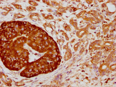 IHC image of RAC07229 diluted at 1:155 and staining in paraffin-embedded human pancreatic cancer performed on a Leica BondTM system. After dewaxing and hydration, antigen retrieval was mediated by high pressure in a citrate buffer (pH 6.0). Section was blocked with 10% normal goat serum 30min at RT. Then primary antibody (1% BSA) was incubated at 4? overnight. The primary is detected by a biotinylated secondary antibody and visualized using an HRP conjugated SP system.