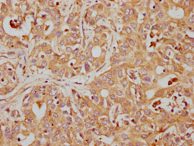 IHC image of RAC07229 diluted at 1:155 and staining in paraffin-embedded human liver cancer performed on a Leica BondTM system. After dewaxing and hydration, antigen retrieval was mediated by high pressure in a citrate buffer (pH 6.0). Section was blocked with 10% normal goat serum 30min at RT. Then primary antibody (1% BSA) was incubated at 4? overnight. The primary is detected by a biotinylated secondary antibody and visualized using an HRP conjugated SP system.
