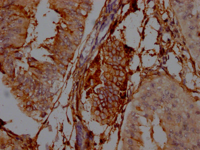 IHC image of RAC07230 diluted at 1:100 and staining in paraffin-embedded human endometrial cancer performed on a Leica BondTM system. After dewaxing and hydration, antigen retrieval was mediated by high pressure in a citrate buffer (pH 6.0). Section was blocked with 10% normal goat serum 30min at RT. Then primary antibody (1% BSA) was incubated at 4? overnight. The primary is detected by a Goat anti-rabbit IgG polymer labeled by HRP and visualized using 0.05% DAB.