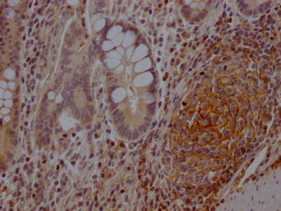 IHC image of RAC07230 diluted at 1:100 and staining in paraffin-embedded human colon cancer performed on a Leica BondTM system. After dewaxing and hydration, antigen retrieval was mediated by high pressure in a citrate buffer (pH 6.0). Section was blocked with 10% normal goat serum 30min at RT. Then primary antibody (1% BSA) was incubated at 4? overnight. The primary is detected by a Goat anti-rabbit IgG polymer labeled by HRP and visualized using 0.05% DAB.