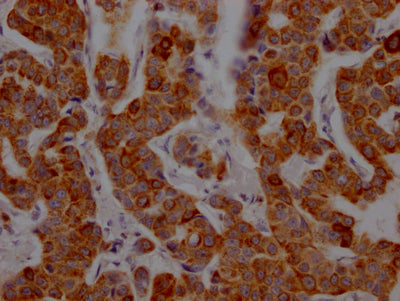IHC image of RAC07231 diluted at 1:100 and staining in paraffin-embedded human breast cancer performed on a Leica BondTM system. After dewaxing and hydration, antigen retrieval was mediated by high pressure in a citrate buffer (pH 6.0). Section was blocked with 10% normal goat serum 30min at RT. Then primary antibody (1% BSA) was incubated at 4? overnight. The primary is detected by a Goat anti-rabbit IgG polymer labeled by HRP and visualized using 0.05% DAB.