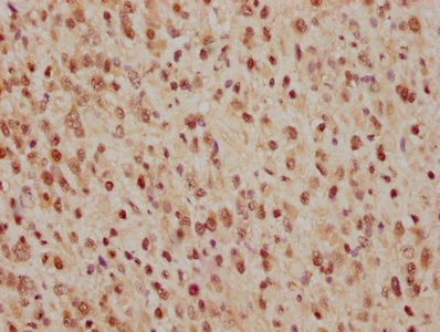 IHC image of RAC07234 diluted at 1:165 and staining in paraffin-embedded human glioma cancer performed on a Leica BondTM system. After dewaxing and hydration, antigen retrieval was mediated by high pressure in a citrate buffer (pH 6.0). Section was blocked with 10% normal goat serum 30min at RT. Then primary antibody (1% BSA) was incubated at 4? overnight. The primary is detected by a biotinylated secondary antibody and visualized using an HRP conjugated SP system.