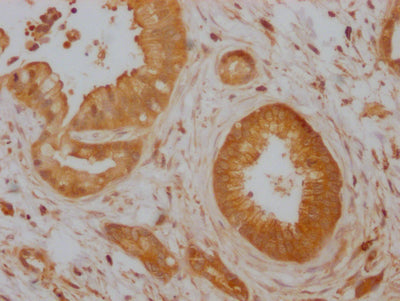 IHC image of RAC07235 diluted at 1:100 and staining in paraffin-embedded human pancreatic cancer performed on a Leica BondTM system. After dewaxing and hydration, antigen retrieval was mediated by high pressure in a citrate buffer (pH 6.0). Section was blocked with 10% normal goat serum 30min at RT. Then primary antibody (1% BSA) was incubated at 4? overnight. The primary is detected by a Goat anti-rabbit IgG polymer labeled by HRP and visualized using 0.05% DAB.