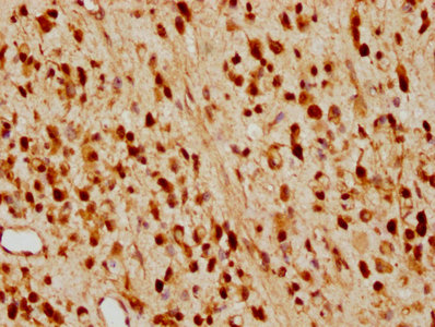 IHC image of RAC07241 diluted at 1:97.5 and staining in paraffin-embedded human glioma cancer performed on a Leica BondTM system. After dewaxing and hydration, antigen retrieval was mediated by high pressure in a citrate buffer (pH 6.0). Section was blocked with 10% normal goat serum 30min at RT. Then primary antibody (1% BSA) was incubated at 4? overnight. The primary is detected by a biotinylated secondary antibody and visualized using an HRP conjugated SP system.