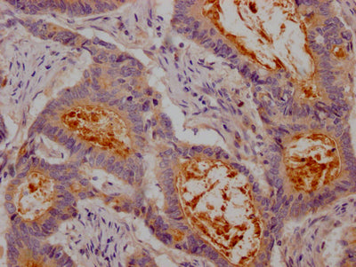 IHC image of RAC07243 diluted at 1:100 and staining in paraffin-embedded human colon cancer performed on a Leica BondTM system. After dewaxing and hydration, antigen retrieval was mediated by high pressure in a citrate buffer (pH 6.0). Section was blocked with 10% normal goat serum 30min at RT. Then primary antibody (1% BSA) was incubated at 4? overnight. The primary is detected by a Goat anti-rabbit IgG polymer labeled by HRP and visualized using 0.05% DAB.