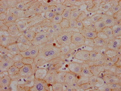 IHC image of RAC07243 diluted at 1:100 and staining in paraffin-embedded human liver cancer performed on a Leica BondTM system. After dewaxing and hydration, antigen retrieval was mediated by high pressure in a citrate buffer (pH 6.0). Section was blocked with 10% normal goat serum 30min at RT. Then primary antibody (1% BSA) was incubated at 4? overnight. The primary is detected by a Goat anti-rabbit IgG polymer labeled by HRP and visualized using 0.05% DAB.