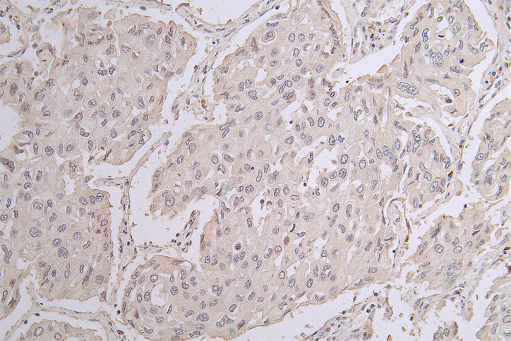 IHC image of RAC07246 diluted at 1:50 and staining in paraffin-embedded human lung cancer performed on a Leica BondTM system. After dewaxing and hydration, antigen retrieval was mediated by high pressure in a citrate buffer (pH 6.0). Section was blocked with 10% normal goat serum 30min at RT. Then primary antibody (1% BSA) was incubated at 4Â°C overnight. The primary is detected by a Goat anti-rabbit polymer IgG labeled by HRP and visualized using 0.22% DAB.