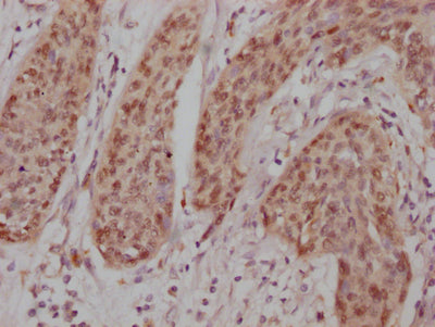 IHC image of RAC07248 diluted at 1:100 and staining in paraffin-embedded human cervical cancer performed on a Leica BondTM system. After dewaxing and hydration, antigen retrieval was mediated by high pressure in a citrate buffer (pH 6.0). Section was blocked with 10% normal goat serum 30min at RT. Then primary antibody (1% BSA) was incubated at 4? overnight. The primary is detected by a Goat anti-rabbit IgG polymer labeled by HRP and visualized using 0.05% DAB.