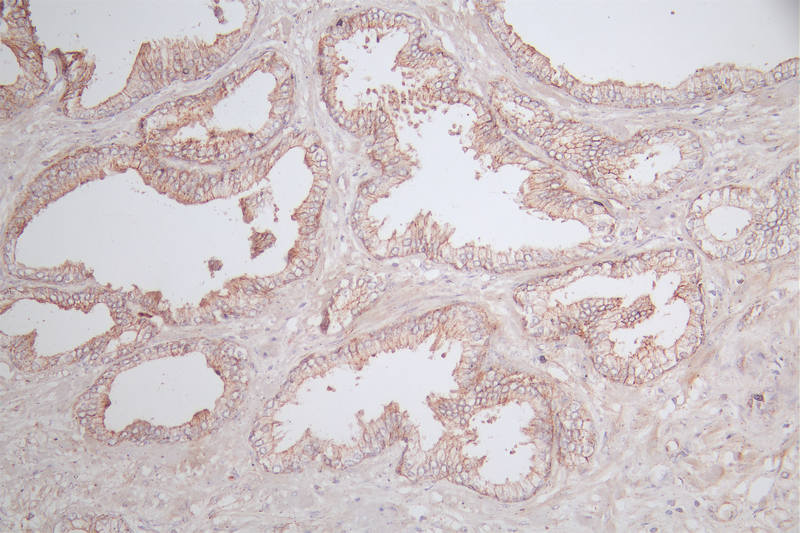 IHC image of RAC07252 diluted at 1:100 and staining in paraffin-embedded human prostate tissue performed on a Leica BondTM system. After dewaxing and hydration, antigen retrieval was mediated by high pressure in a citrate buffer (pH 6.0). Section was blocked with 10% normal goat serum 30min at RT. Then primary antibody (1% BSA) was incubated at 4Â°C overnight. The primary is detected by a Goat anti-rabbit polymer IgG labeled by HRP and visualized using 0.77% DAB.