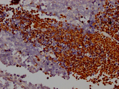 IHC image of RAC07253 diluted at 1:100 and staining in paraffin-embedded human lung cancer performed on a Leica BondTM system. After dewaxing and hydration, antigen retrieval was mediated by high pressure in a citrate buffer (pH 6.0). Section was blocked with 10% normal goat serum 30min at RT. Then primary antibody (1% BSA) was incubated at 4? overnight. The primary is detected by a Goat anti-rabbit IgG polymer labeled by HRP and visualized using 0.05% DAB.