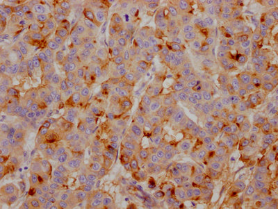 IHC image of RAC07254 diluted at 1:100 and staining in paraffin-embedded human breast cancer performed on a Leica BondTM system. After dewaxing and hydration, antigen retrieval was mediated by high pressure in a citrate buffer (pH 6.0). Section was blocked with 10% normal goat serum 30min at RT. Then primary antibody (1% BSA) was incubated at 4? overnight. The primary is detected by a Goat anti-rabbit IgG polymer labeled by HRP and visualized using 0.05% DAB.