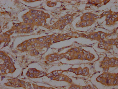 IHC image of RAC07255 diluted at 1:100 and staining in paraffin-embedded human breast cancer performed on a Leica BondTM system. After dewaxing and hydration, antigen retrieval was mediated by high pressure in a citrate buffer (pH 6.0). Section was blocked with 10% normal goat serum 30min at RT. Then primary antibody (1% BSA) was incubated at 4? overnight. The primary is detected by a Goat anti-rabbit IgG polymer labeled by HRP and visualized using 0.05% DAB.