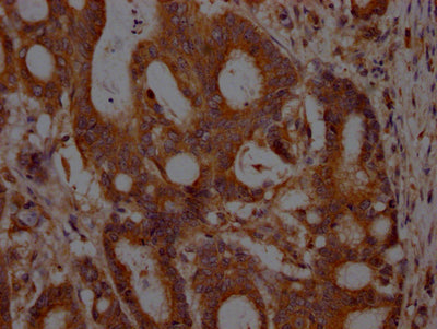 IHC image of RAC07255 diluted at 1:100 and staining in paraffin-embedded human colon cancer performed on a Leica BondTM system. After dewaxing and hydration, antigen retrieval was mediated by high pressure in a citrate buffer (pH 6.0). Section was blocked with 10% normal goat serum 30min at RT. Then primary antibody (1% BSA) was incubated at 4? overnight. The primary is detected by a Goat anti-rabbit IgG polymer labeled by HRP and visualized using 0.05% DAB.