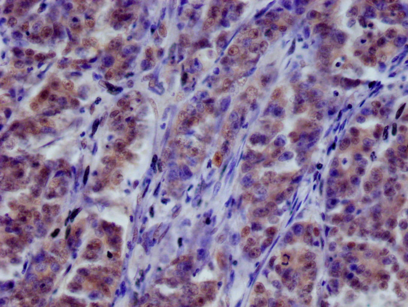 IHC image of RAC07260 diluted at 1:100 and staining in paraffin-embedded human colon cancer performed on a Leica BondTM system. After dewaxing and hydration, antigen retrieval was mediated by high pressure in a citrate buffer (pH 6.0). Section was blocked with 10% normal goat serum 30min at RT. Then primary antibody (1% BSA) was incubated at 4Â°C overnight. The primary is detected by a Goat anti-rabbit polymer IgG labeled by HRP and visualized using 0.05% DAB.