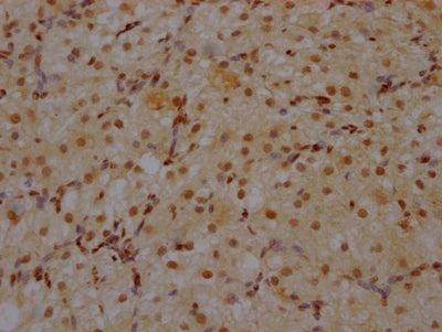 IHC image of RAC07265 diluted at 1:100 and staining in paraffin-embedded human ovarian tissue performed on a Leica BondTM system. After dewaxing and hydration, antigen retrieval was mediated by high pressure in a citrate buffer (pH 6.0). Section was blocked with 10% normal goat serum 30min at RT. Then primary antibody (1% BSA) was incubated at 4? overnight. The primary is detected by a Goat anti-rabbit IgG polymer labeled by HRP and visualized using 0.05% DAB.