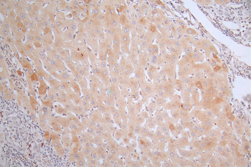 IHC image of RAC07266 diluted at 1:50 and staining in paraffin-embedded human liver cancer performed on a Leica BondTM system. After dewaxing and hydration, antigen retrieval was mediated by high pressure in a citrate buffer (pH 6.0). Section was blocked with 10% normal goat serum 30min at RT. Then primary antibody (1% BSA) was incubated at 4Â°C overnight. The primary is detected by a Goat anti-rabbit polymer IgG labeled by HRP and visualized using 0.38% DAB.