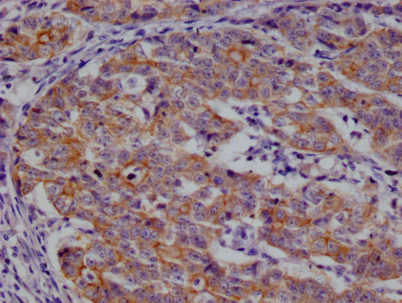 IHC image of RAC07268 diluted at 1:100 and staining in paraffin-embedded human colon cancer performed on a Leica BondTM system. After dewaxing and hydration, antigen retrieval was mediated by high pressure in a citrate buffer (pH 6.0). Section was blocked with 10% normal goat serum 30min at RT. Then primary antibody (1% BSA) was incubated at 4Â°C overnight. The primary is detected by a Goat anti-rabbit polymer IgG labeled by HRP and visualized using 0.05% DAB.