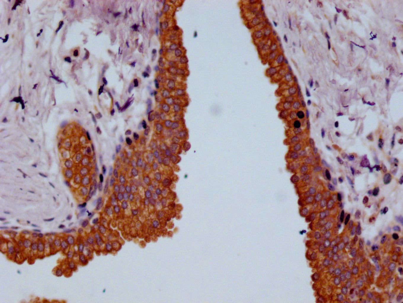 IHC image of RAC07268 diluted at 1:100 and staining in paraffin-embedded human prostate cancer performed on a Leica BondTM system. After dewaxing and hydration, antigen retrieval was mediated by high pressure in a citrate buffer (pH 6.0). Section was blocked with 10% normal goat serum 30min at RT. Then primary antibody (1% BSA) was incubated at 4Â°C overnight. The primary is detected by a Goat anti-rabbit polymer IgG labeled by HRP and visualized using 0.05% DAB.