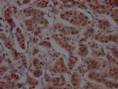 IHC image of RAC07272 diluted at 1:100 and staining in paraffin-embedded human breast cancer performed on a Leica BondTM system. After dewaxing and hydration, antigen retrieval was mediated by high pressure in a citrate buffer (pH 6.0). Section was blocked with 10% normal goat serum 30min at RT. Then primary antibody (1% BSA) was incubated at 4? overnight. The primary is detected by a Goat anti-rabbit IgG polymer labeled by HRP and visualized using 0.05% DAB.