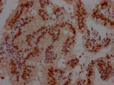 IHC image of RAC07272 diluted at 1:100 and staining in paraffin-embedded human prostate cancer performed on a Leica BondTM system. After dewaxing and hydration, antigen retrieval was mediated by high pressure in a citrate buffer (pH 6.0). Section was blocked with 10% normal goat serum 30min at RT. Then primary antibody (1% BSA) was incubated at 4? overnight. The primary is detected by a Goat anti-rabbit IgG polymer labeled by HRP and visualized using 0.05% DAB.