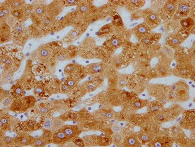IHC image of RAC07279 diluted at 1:100 and staining in paraffin-embedded human liver cancer performed on a Leica BondTM system. After dewaxing and hydration, antigen retrieval was mediated by high pressure in a citrate buffer (pH 6.0). Section was blocked with 10% normal goat serum 30min at RT. Then primary antibody (1% BSA) was incubated at 4? overnight. The primary is detected by a Goat anti-rabbit IgG polymer labeled by HRP and visualized using 0.05% DAB.