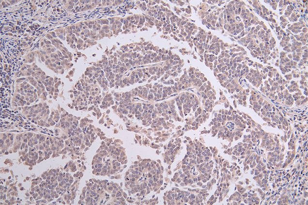 IHC image of RAC07283 diluted at 1:50 and staining in paraffin-embedded human cervical cancer performed on a Leica BondTM system. After dewaxing and hydration, antigen retrieval was mediated by high pressure in a citrate buffer (pH 6.0). Section was blocked with 10% normal goat serum 30min at RT. Then primary antibody (1% BSA) was incubated at 4Â°C overnight. The primary is detected by a Goat anti-rabbit polymer IgG labeled by HRP and visualized using 0.46% DAB.