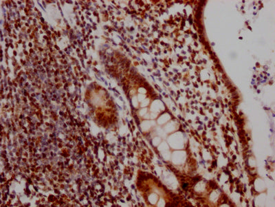 IHC image of RAC07286 diluted at 1:100 and staining in paraffin-embedded human colon cancer performed on a Leica BondTM system. After dewaxing and hydration, antigen retrieval was mediated by high pressure in a citrate buffer (pH 6.0). Section was blocked with 10% normal goat serum 30min at RT. Then primary antibody (1% BSA) was incubated at 4? overnight. The primary is detected by a Goat anti-rabbit IgG polymer labeled by HRP and visualized using 0.05% DAB.