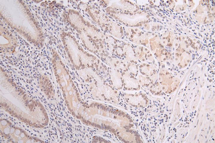 IHC image of RAC07290 diluted at 1:50 and staining in paraffin-embedded human gastric cancer performed on a Leica BondTM system. After dewaxing and hydration, antigen retrieval was mediated by high pressure in a citrate buffer (pH 6.0). Section was blocked with 10% normal goat serum 30min at RT. Then primary antibody (1% BSA) was incubated at 4Â°C overnight. The primary is detected by a Goat anti-rabbit polymer IgG labeled by HRP and visualized using 0.67% DAB.