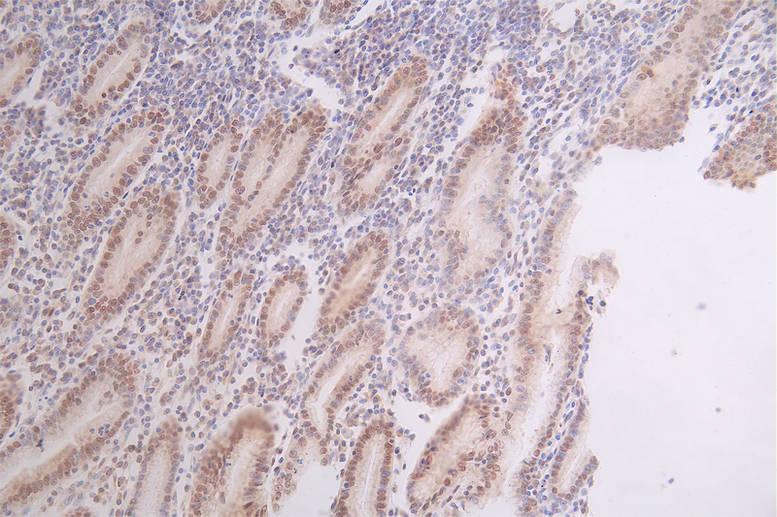 IHC image of RAC07290 diluted at 1:50 and staining in paraffin-embedded human breast cancer performed on a Leica BondTM system. After dewaxing and hydration, antigen retrieval was mediated by high pressure in a citrate buffer (pH 6.0). Section was blocked with 10% normal goat serum 30min at RT. Then primary antibody (1% BSA) was incubated at 4Â°C overnight. The primary is detected by a Goat anti-rabbit polymer IgG labeled by HRP and visualized using 0.67% DAB.