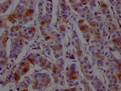 IHC image of RAC07292 diluted at 1:100 and staining in paraffin-embedded human breast cancer performed on a Leica BondTM system. After dewaxing and hydration, antigen retrieval was mediated by high pressure in a citrate buffer (pH 6.0). Section was blocked with 10% normal goat serum 30min at RT. Then primary antibody (1% BSA) was incubated at 4? overnight. The primary is detected by a Goat anti-rabbit IgG polymer labeled by HRP and visualized using 0.05% DAB.