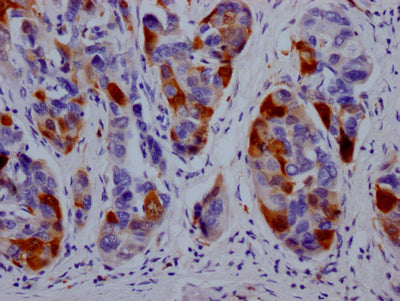 IHC image of RAC07292 diluted at 1:100 and staining in paraffin-embedded human liver cancer performed on a Leica BondTM system. After dewaxing and hydration, antigen retrieval was mediated by high pressure in a citrate buffer (pH 6.0). Section was blocked with 10% normal goat serum 30min at RT. Then primary antibody (1% BSA) was incubated at 4? overnight. The primary is detected by a Goat anti-rabbit IgG polymer labeled by HRP and visualized using 0.05% DAB.